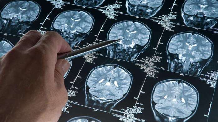 Latest research on Alzheimer's disease